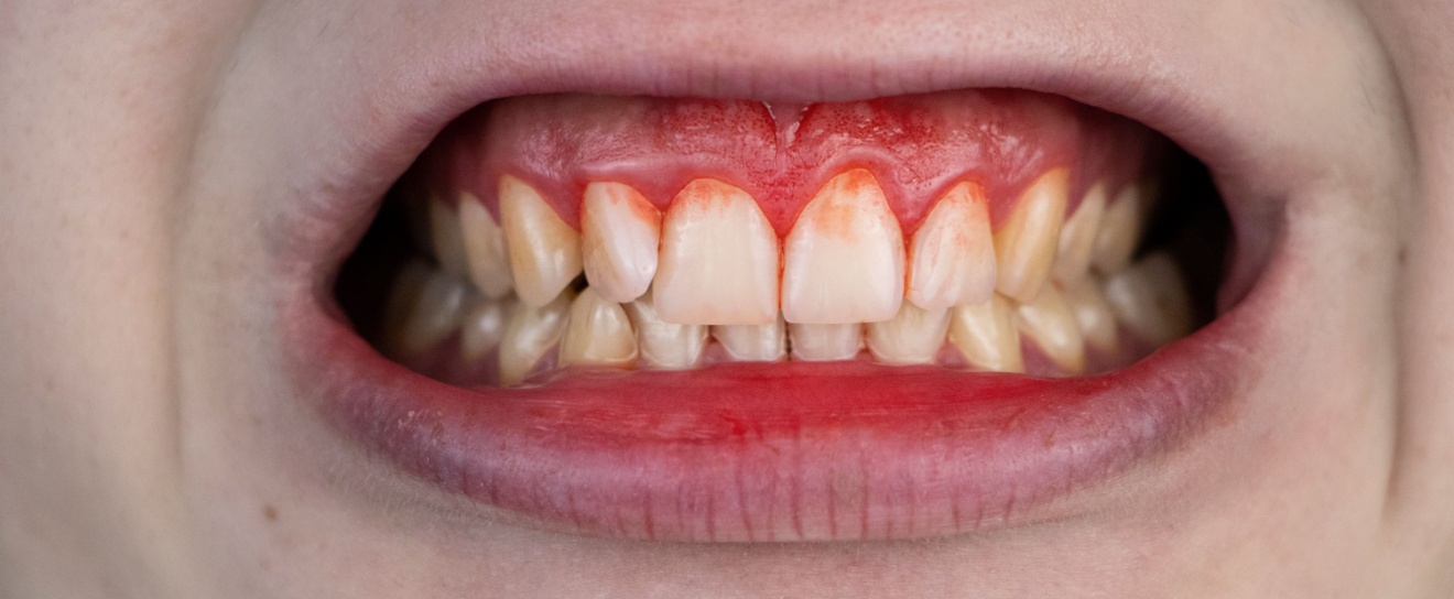 Get Answers to Your Questions About Gum Disease