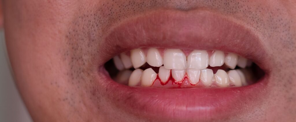 Should I Stop Flossing if It Makes My Gums Bleed?