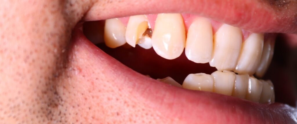 Can My Damaged Tooth Be Saved?