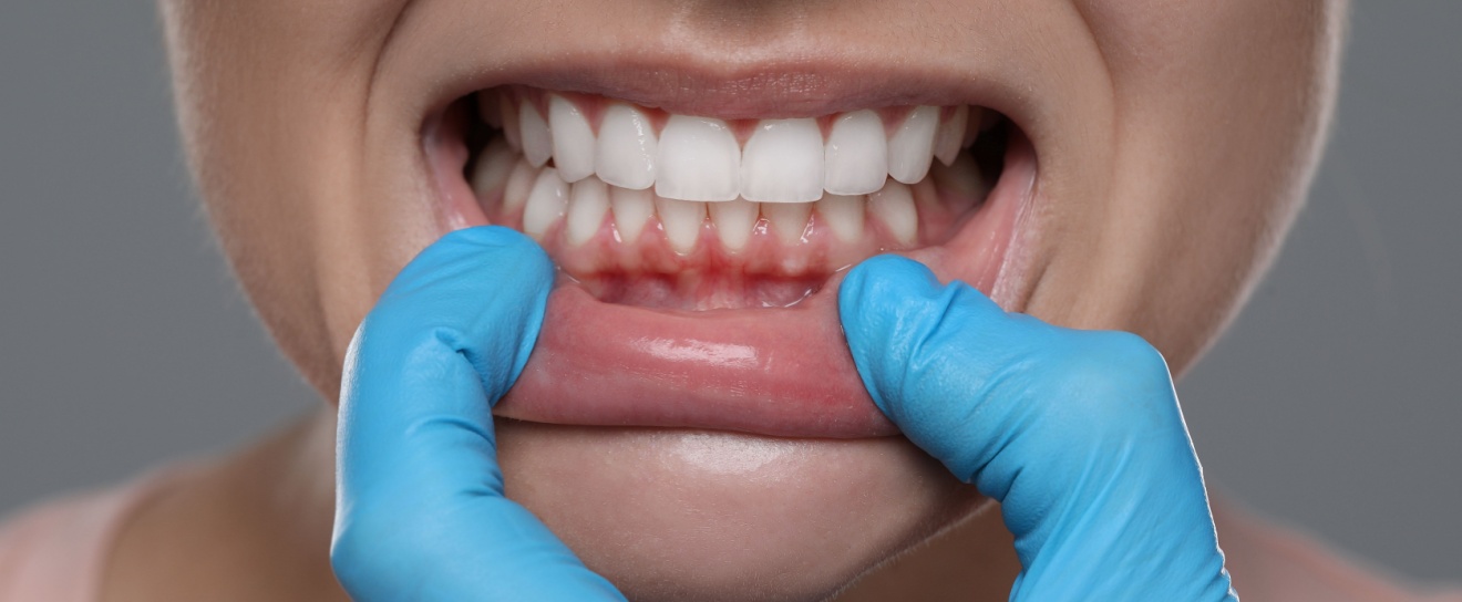 Simple Steps that Will Help You Prevent Gum Disease