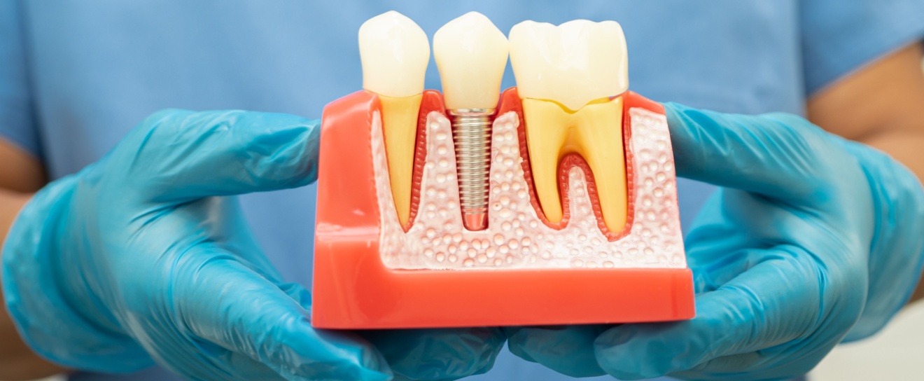 Facts to Know Before You Get a Root Canal