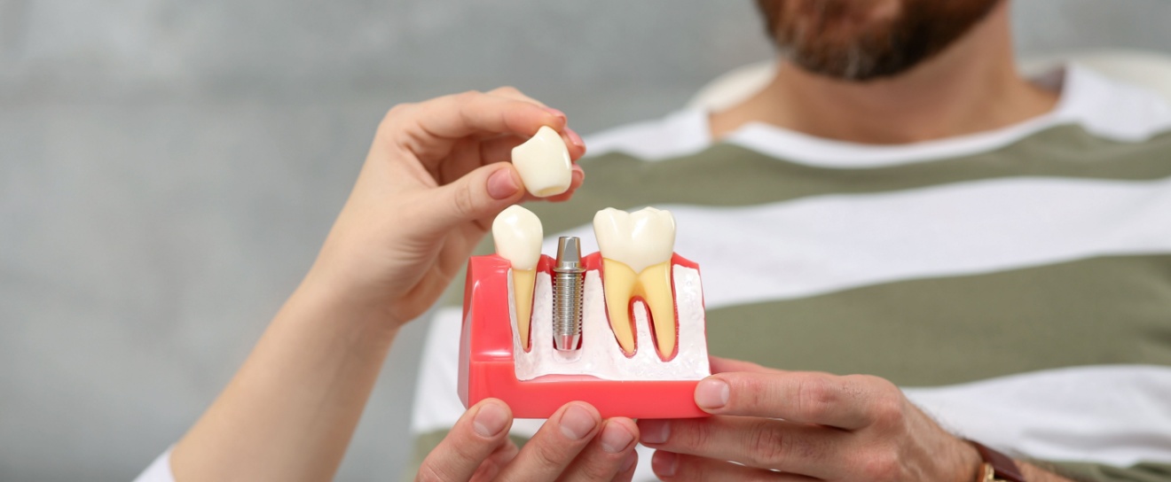 Where Should I Go for Dental Implants in Coralville, IA?