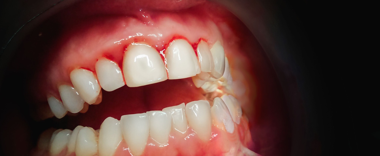 Does Treating Gum Disease Require the Intervention of a Dentist?