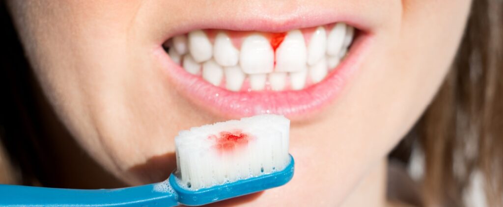 Five Telltale Signs of Gum Disease