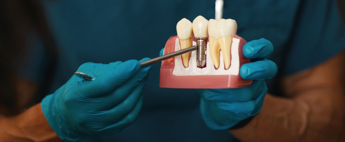 Do Dental Implants Need Ongoing Maintenance?