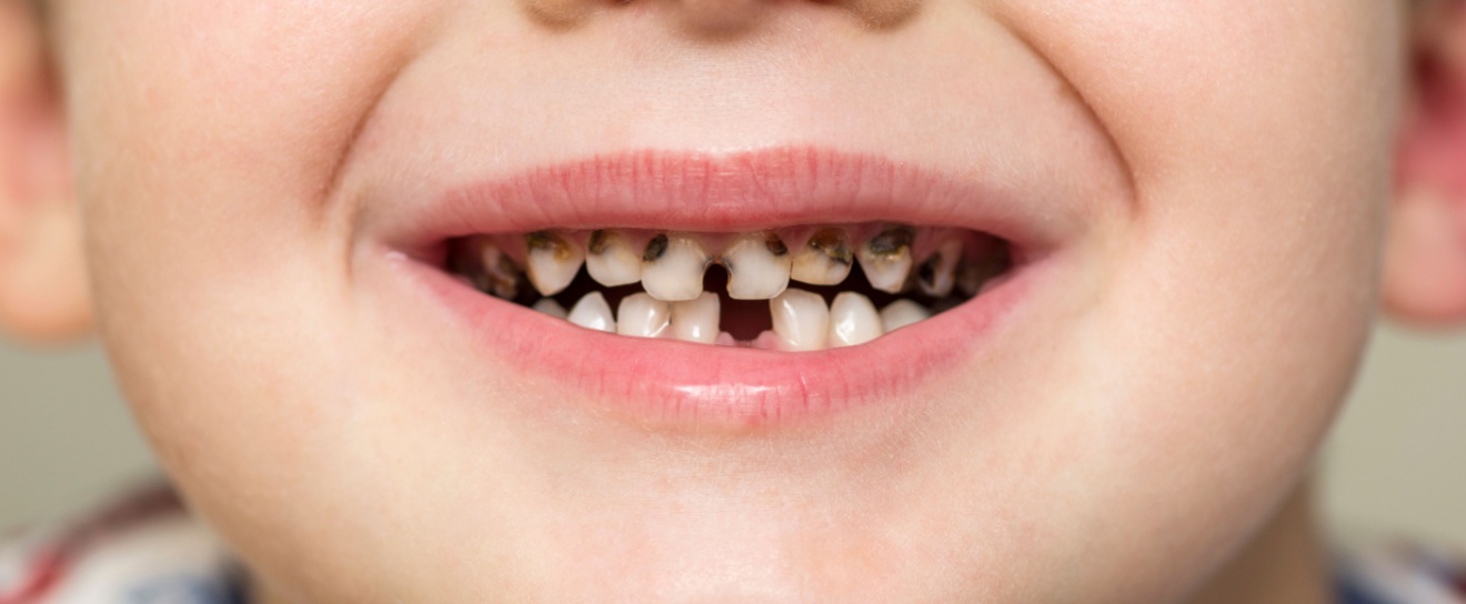 How Can I Help My Child Avoid Cavities?