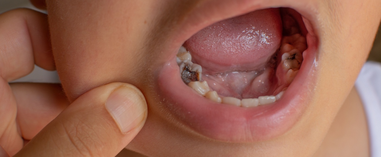 Do Children Get Cavities Easily?