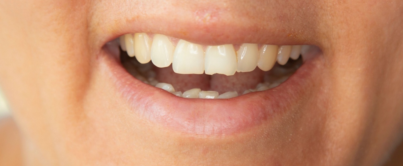 Top 7 Reasons to Choose Coral West Dental for Chipped Tooth Repair