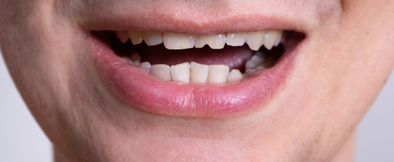 Who’s the Best Dentist for Chipped Tooth Repair in Coralville, IA?