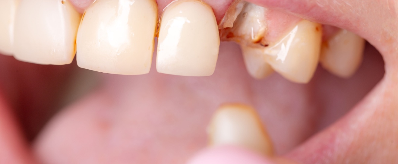 Cracked Tooth or Lost Filling? When to Call an Emergency Dentist in Coralville