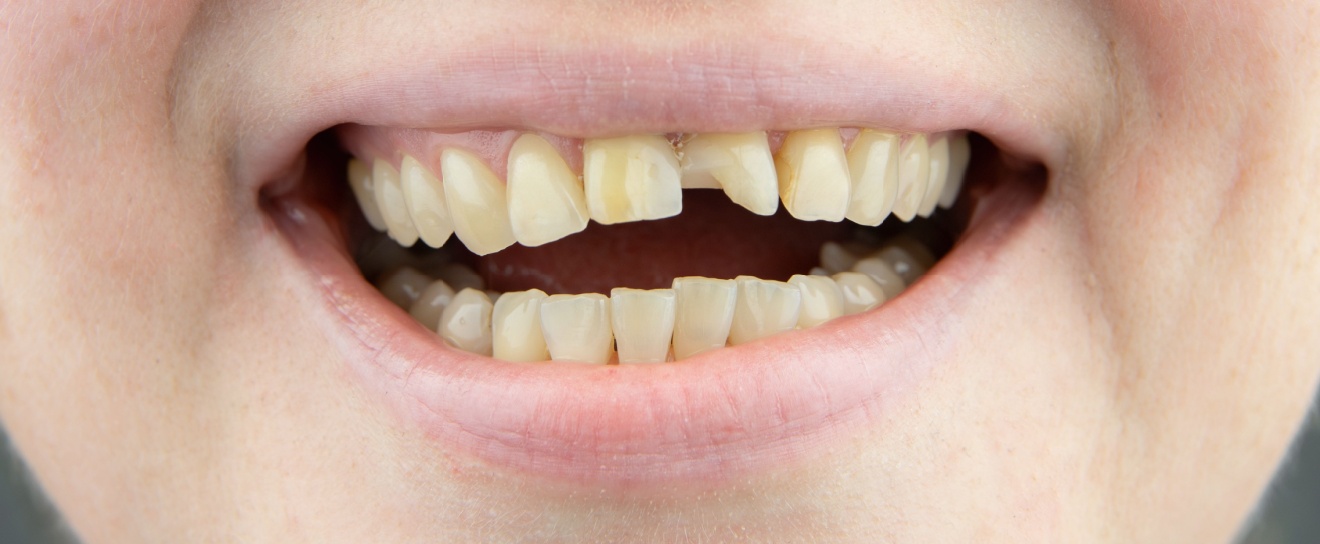 How to Handle a Chipped or Broken Tooth Before Seeing a Dentist in Coralville