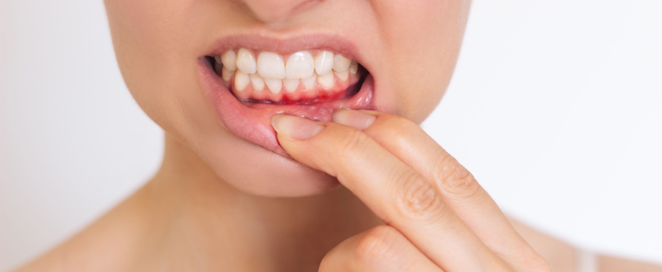 How to Determine If You Actually Have Gum Disease