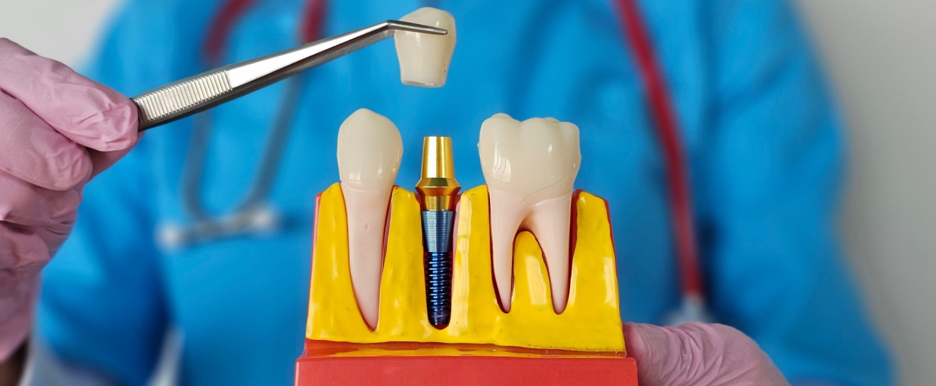 What Are the Top Benefits of Dental Implants?