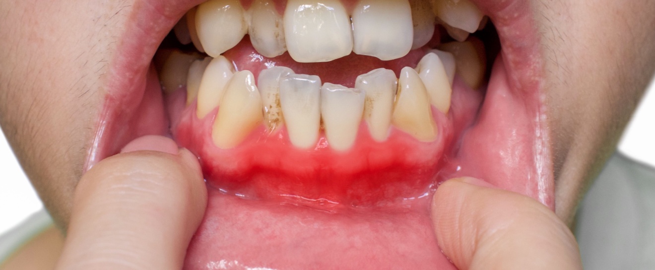 What Is Gum Disease? Signs, Stages, and Treatment Options