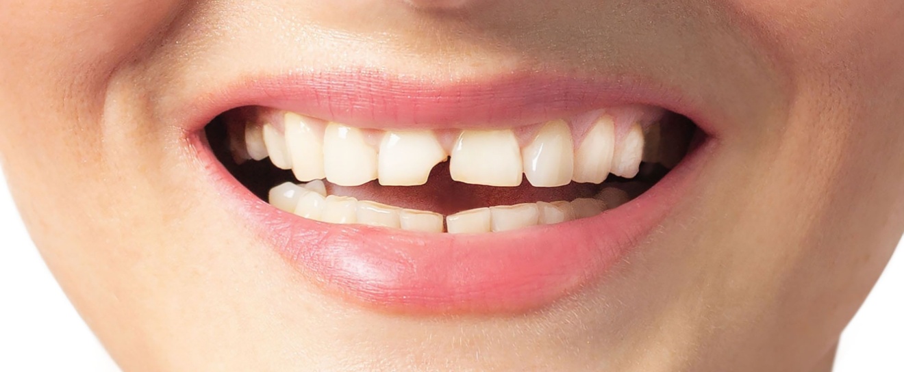 How to Fix a Chipped or Cracked Tooth in Coralville, IA