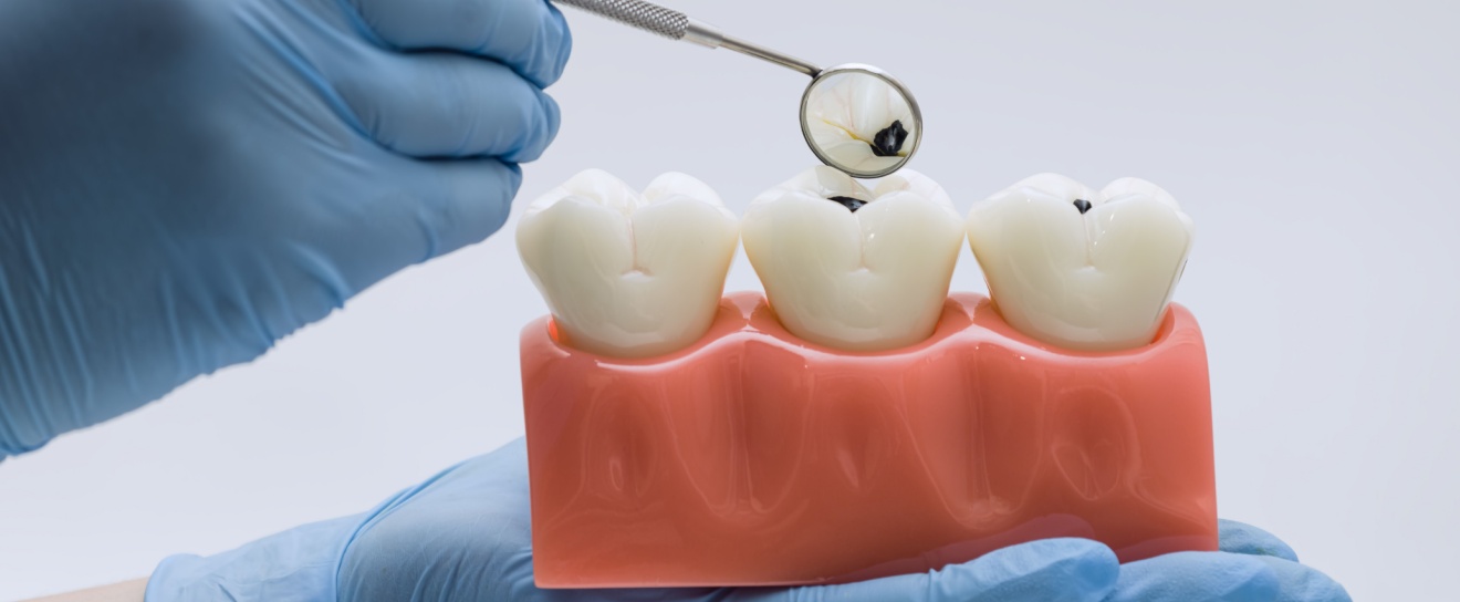 What Causes Cavities (And How to Prevent Them in Coralville, IA)